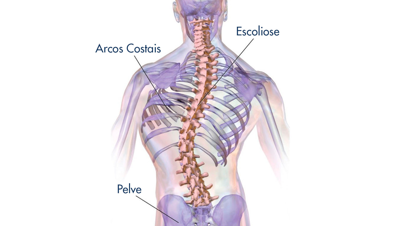 musculação #escoliose #escoliosis #coluna #colunavertebral