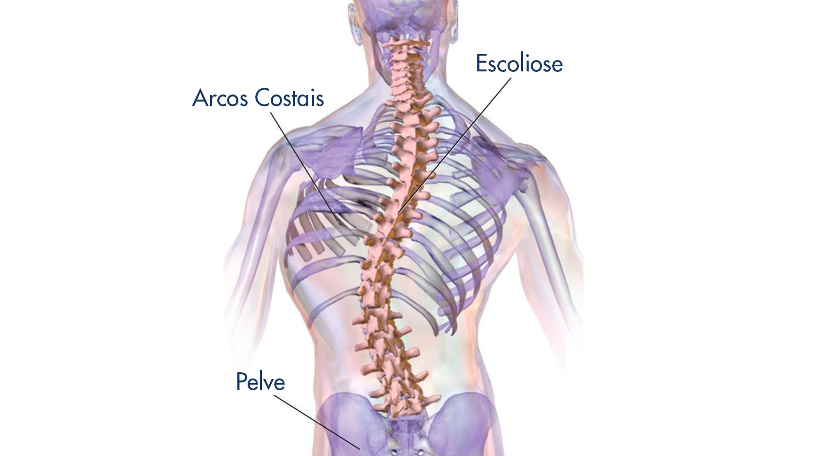 Escoliose - Saiba mais sobre essa deformidade da coluna