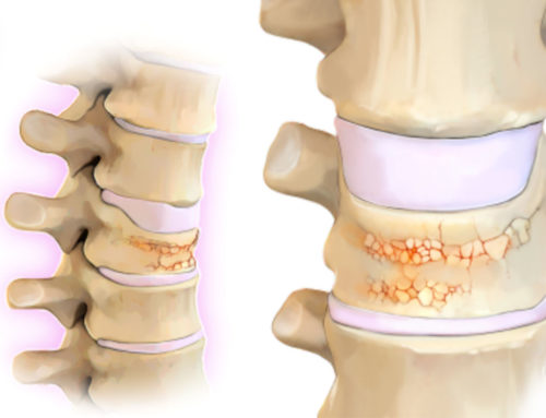 Osteoporose na coluna vertebral