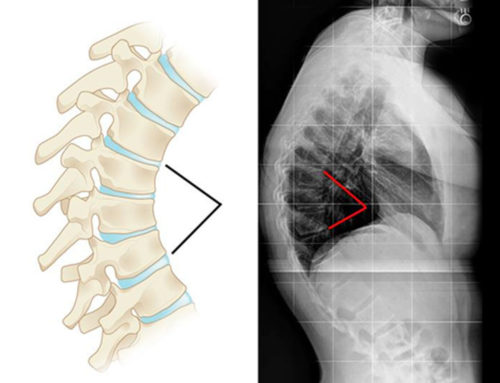 Fratura de coluna em atleta de futebol profissional - Dr. Alberto