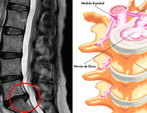 Hérnia de Disco Lombar