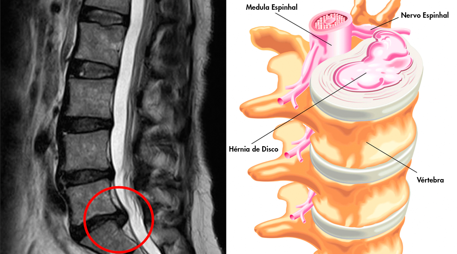 Hérnia de Disco Lombar – Dr. Michel Kanas